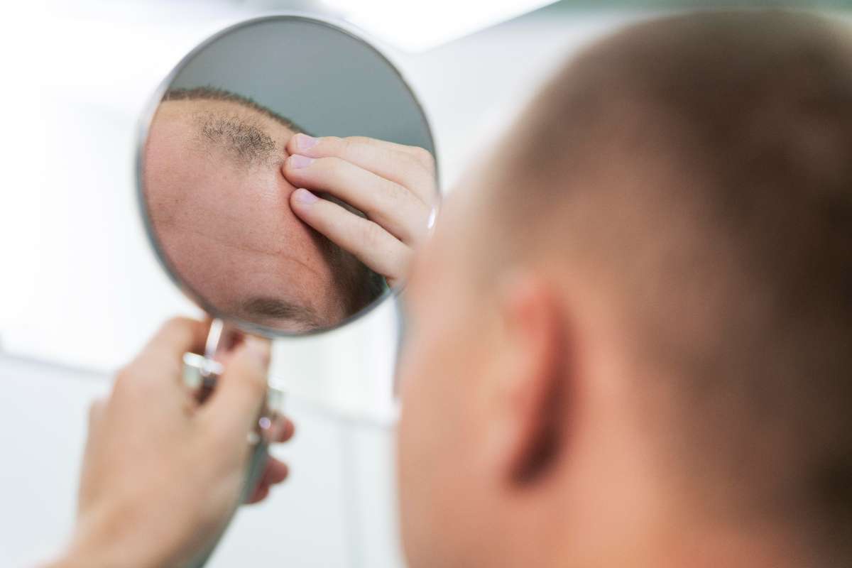 A middle age men suffering from hair loss or alopecia.