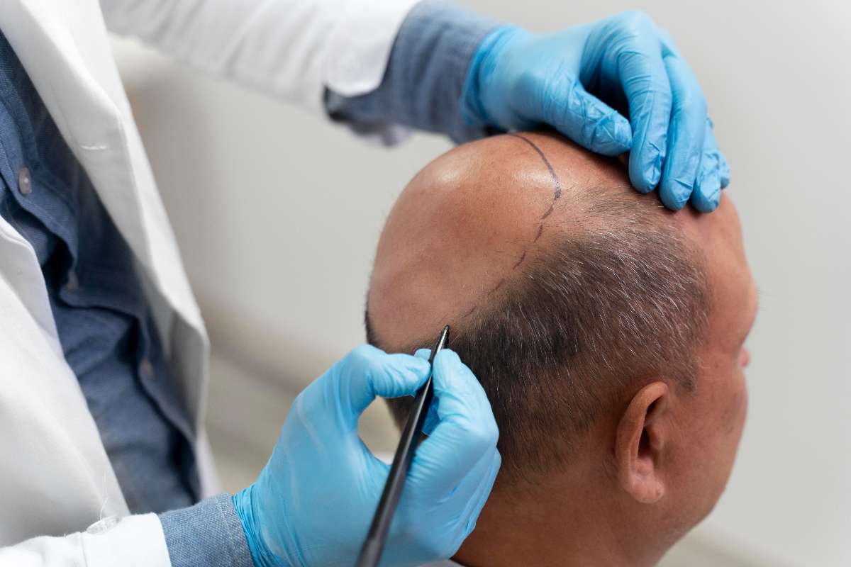 A doctor performing hair transplant on an old man.