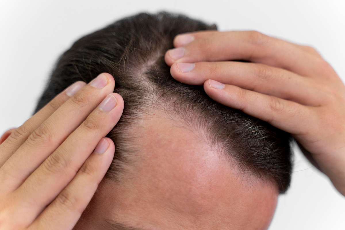 A man  suffering from male pattern baldness, a type of hair loss.