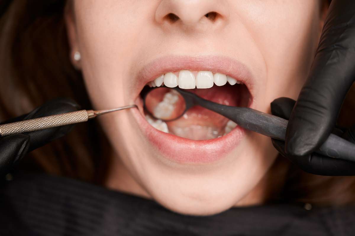 A dentist examines a tooth for plaque formation which leads to tooth decay.